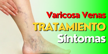 Venas varicosas