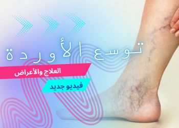 توسع الأوردة